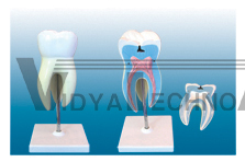 The model of molar tooth attach with caries (maxillary 3roots magnify)